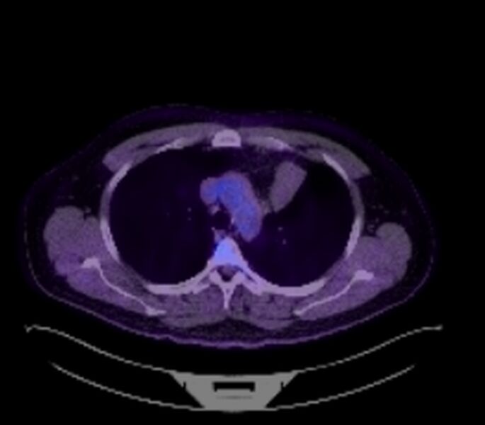 File:Bronchial carcinoid tumor (Radiopaedia 67377-76766 18FDG-PET-CT 22).jpg