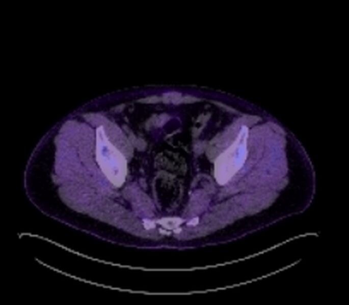 File:Bronchial carcinoid tumor (Radiopaedia 67377-76766 18FDG-PET-CT 56).jpg