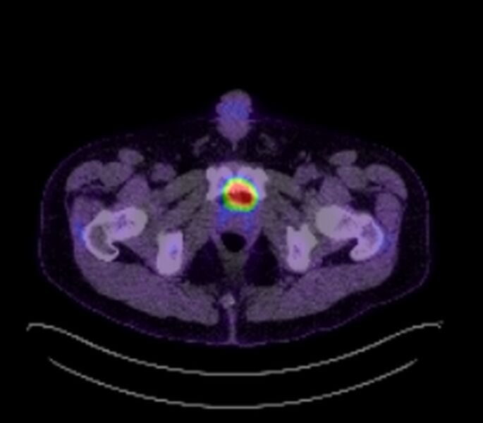 File:Bronchial carcinoid tumor (Radiopaedia 67377-76766 18FDG-PET-CT 60).jpg