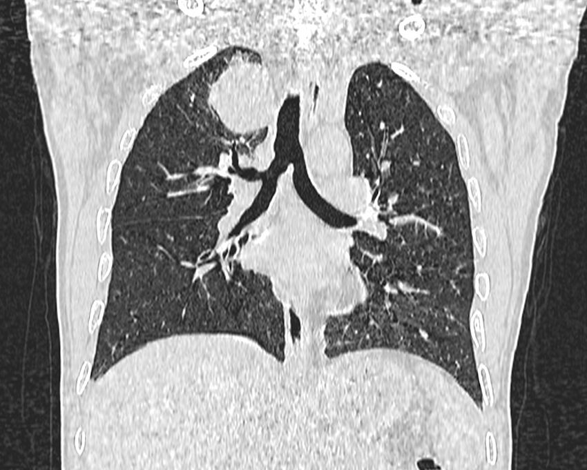 Bronchogenic carcinoma with superior vena cava syndrome (Radiopaedia 36497-38054 Coronal lung window 47).jpg