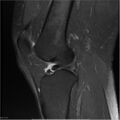 Bucket handle tear - lateral meniscus (Radiopaedia 7246-8187 Sagittal T2 fat sat 12).jpg