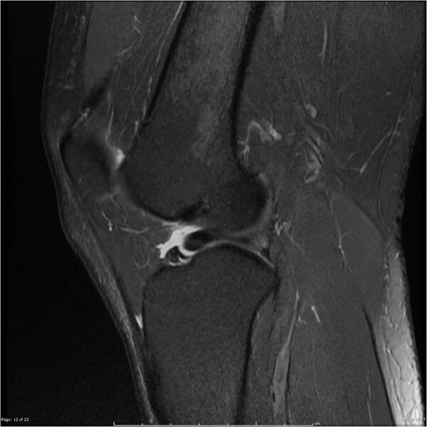 File:Bucket handle tear - lateral meniscus (Radiopaedia 7246-8187 Sagittal T2 fat sat 12).jpg
