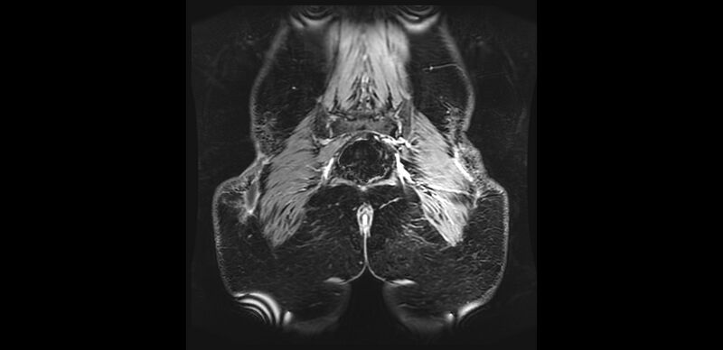File:Buttock filler complications (Radiopaedia 63497-72115 Coronal T1 C+ 46).jpg