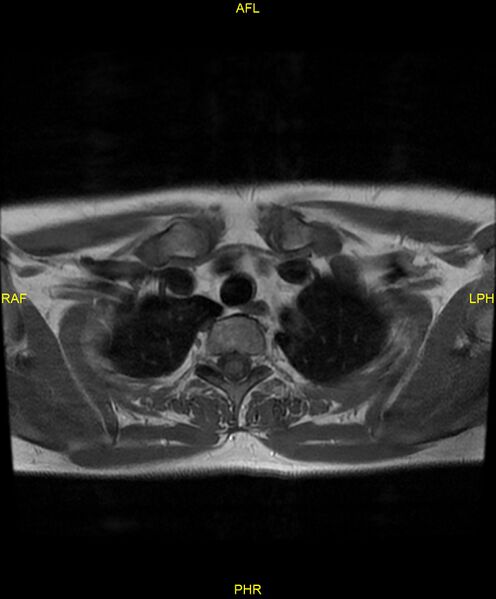 File:C5 nerve sheath tumor (Radiopaedia 85777-101596 Axial T1 28).jpg