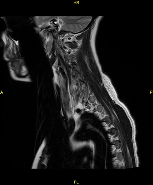 File:C5 nerve sheath tumor (Radiopaedia 85777-101596 Sagittal T2 16).jpg