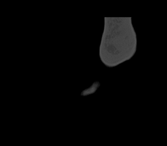 File:Calcaneal tuberosity avulsion fracture (Radiopaedia 22649-22668 Sagittal bone window 1).jpg
