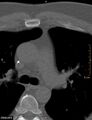 Calcified cardiac fibroma (Radiopaedia 39267-41519 Axial bone window 6).jpg
