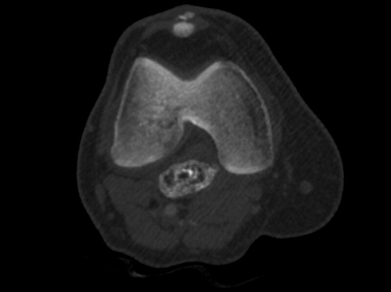 File:Calcified hematoma - popliteal fossa (Radiopaedia 63938-72763 C 10).jpg