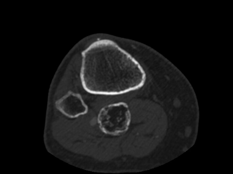 File:Calcified hematoma - popliteal fossa (Radiopaedia 63938-72763 C 80).jpg