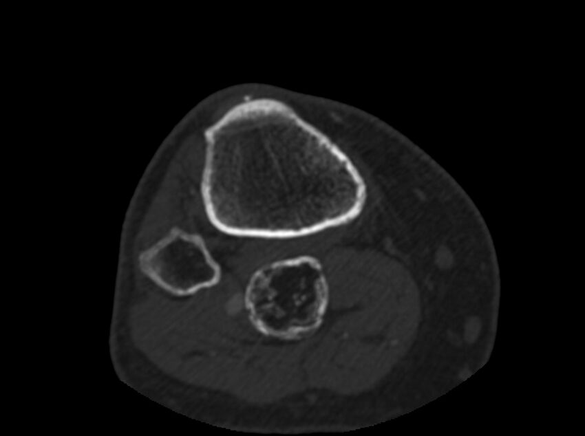 Calcified hematoma - popliteal fossa (Radiopaedia 63938-72763 C 80).jpg