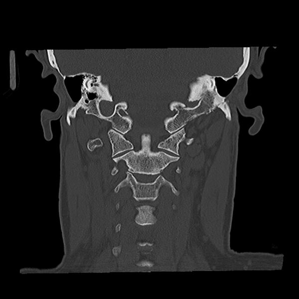 File:Canal up mastoidectomy (Radiopaedia 78108-90638 Coronal bone window 39).jpg