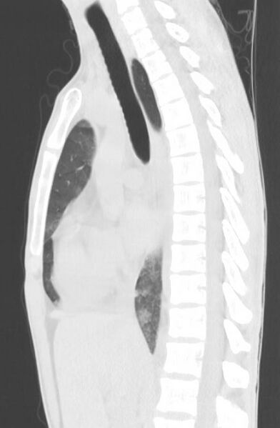 File:Cannabis-induced diffuse alveolar hemorrhage (Radiopaedia 89834-106946 Sagittal lung window 68).jpg