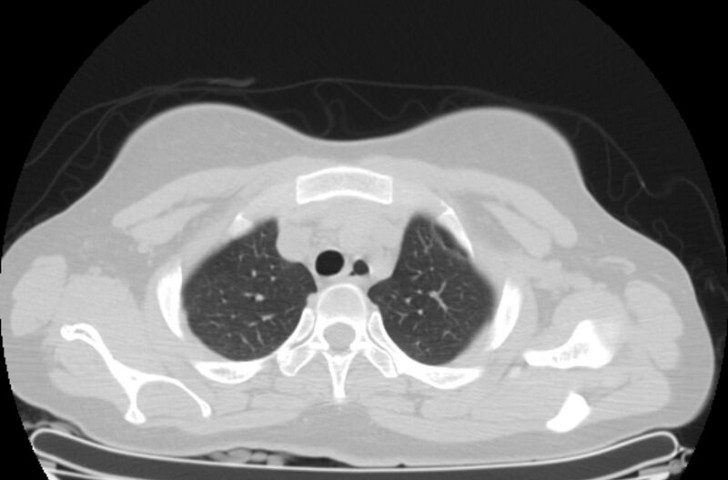 File:Cannonball metastases - uterine choriocarcinoma (Radiopaedia 70137-80173 Axial lung window 4).jpg