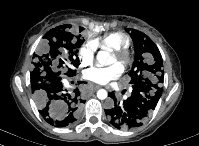 File:Cannonball metastases from breast cancer (Radiopaedia 91024-108569 A 70).jpg