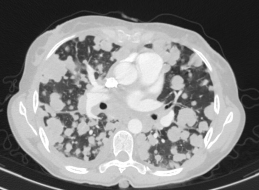 Cannonball metastases from breast cancer (Radiopaedia 91024-108569 Axial lung window 47).jpg