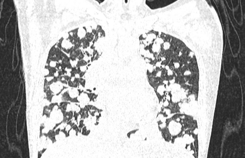 File:Cannonball metastases from breast cancer (Radiopaedia 91024-108569 Coronal lung window 66).jpg