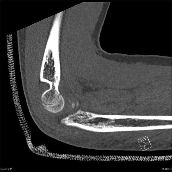 File:Capitellum fracture (Radiopaedia 23352-23426 Sagittal bone window 22).jpg