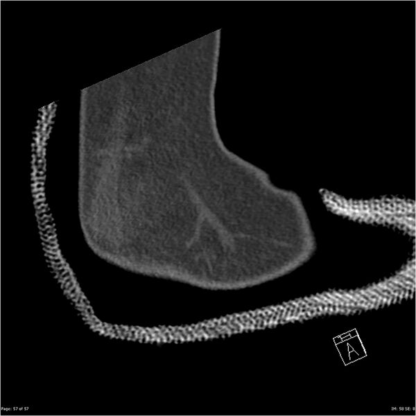File:Capitellum fracture (Radiopaedia 23352-23426 Sagittal bone window 57).jpg