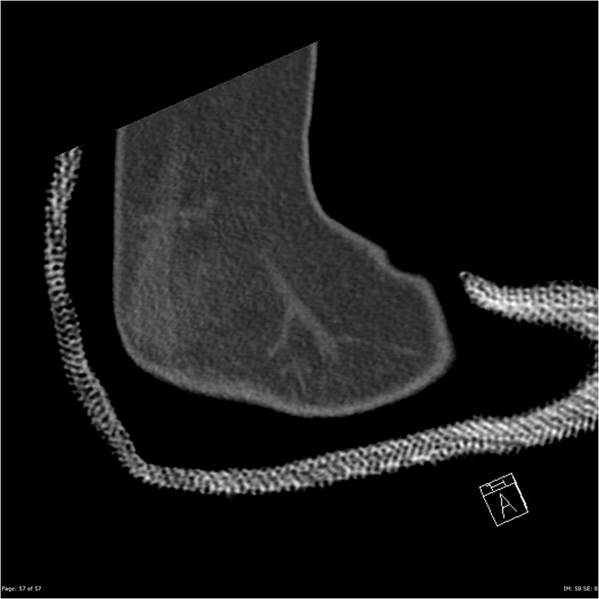 Capitellum fracture (Radiopaedia 23352-23426 Sagittal bone window 57).jpg