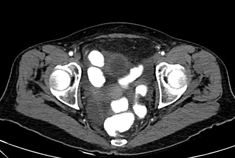 File:Carcinoid mesenteric tumor complicated by chylous ascites (Radiopaedia 76312-88926 A 70).jpg