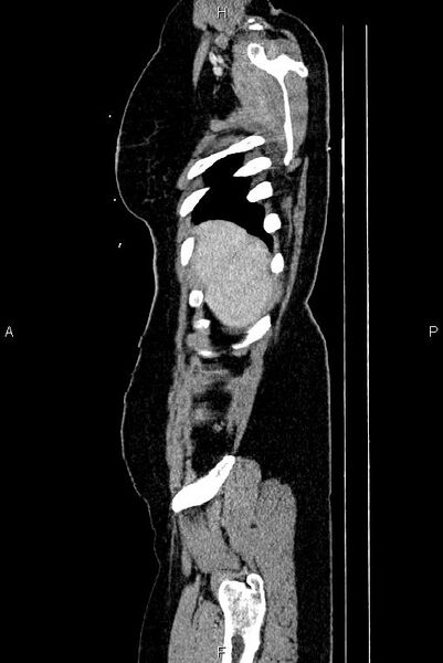 File:Carcinoma of uterine cervix (Radiopaedia 85861-101700 D 2).jpg