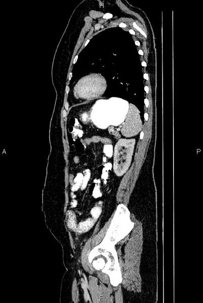 File:Carcinoma of uterine cervix (Radiopaedia 85861-101700 D 64).jpg
