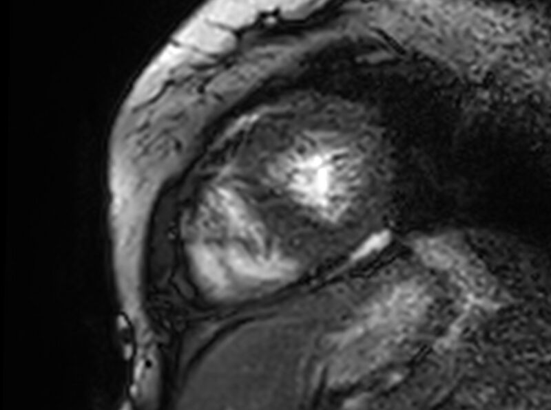 File:Cardiac amyloidosis (Radiopaedia 61600-69579 Short axis bSSFP 89).jpg