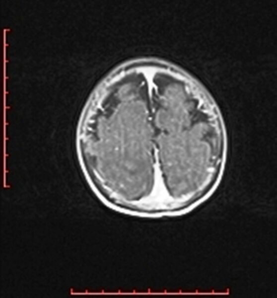 File:Cardiac rhabdomyoma - tuberous sclerosis (Radiopaedia 70089-80114 Axial T1 C+ fat sat 97).jpg