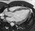Cardiac sarcoidosis (Radiopaedia 39811-42243 LVOT cine images 3).jpg