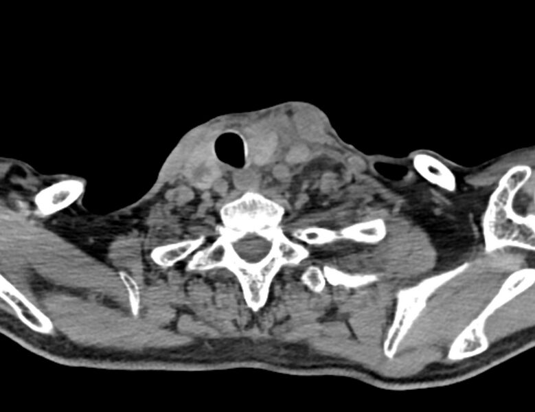 File:Carotid artery pseudoaneurysm (Radiopaedia 84030-99259 Axial non-contrast 47).jpg