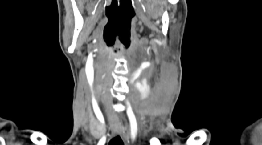 Carotid artery pseudoaneurysm (Radiopaedia 84030-99259 D 46).jpg