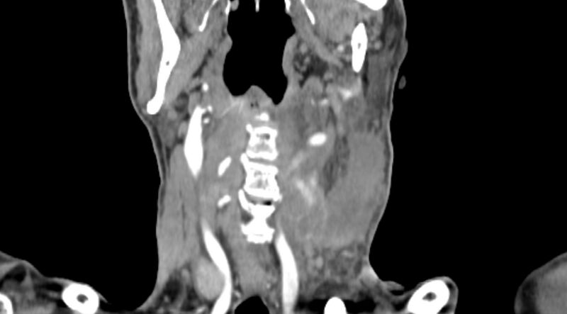 File:Carotid artery pseudoaneurysm (Radiopaedia 84030-99259 D 47).jpg