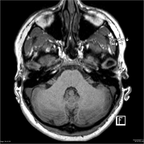 File:Cavernous malformation (cavernous angioma or cavernoma) (Radiopaedia 36675-38237 Axial T1 25).jpg
