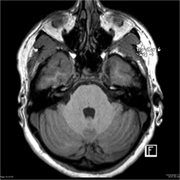 File:Cavernous malformation (cavernous angioma or cavernoma) (Radiopaedia 36675-38237 Axial T1 30).jpg