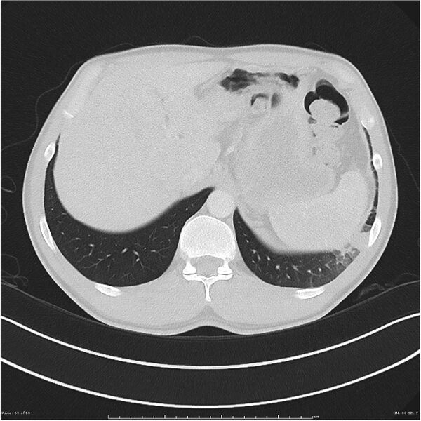 File:Cavitating lung cancer (Radiopaedia 25796-25945 Axial lung window 56).jpg