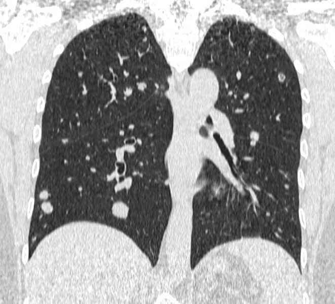 File:Cavitating pulmonary metastases (Radiopaedia 17796-17555 Coronal lung window 16).jpg