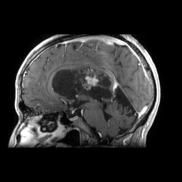 File:Central neurocytoma (Radiopaedia 67618-77021 Sagittal T1 C+ 15).jpg