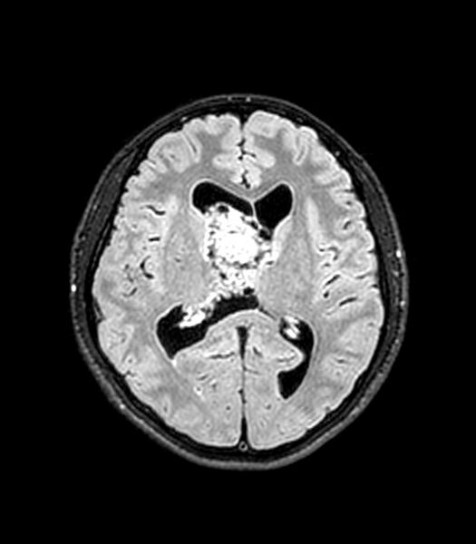 File:Central neurocytoma (Radiopaedia 79320-92380 Axial FLAIR 148).jpg