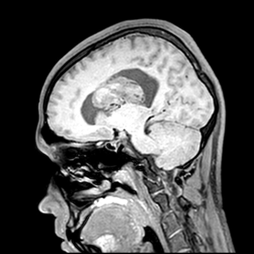 Central neurocytoma (Radiopaedia 79320-92380 Sagittal T1 152).jpg