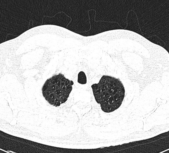 File:Centrilobular pulmonary emphysema (Radiopaedia 26808-26971 Axial lung window 4).jpg