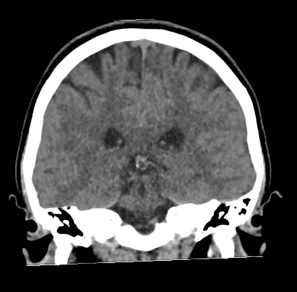 File:Cerebellar agenesis (Radiopaedia 30203-30817 Coronal non-contrast 25).jpg