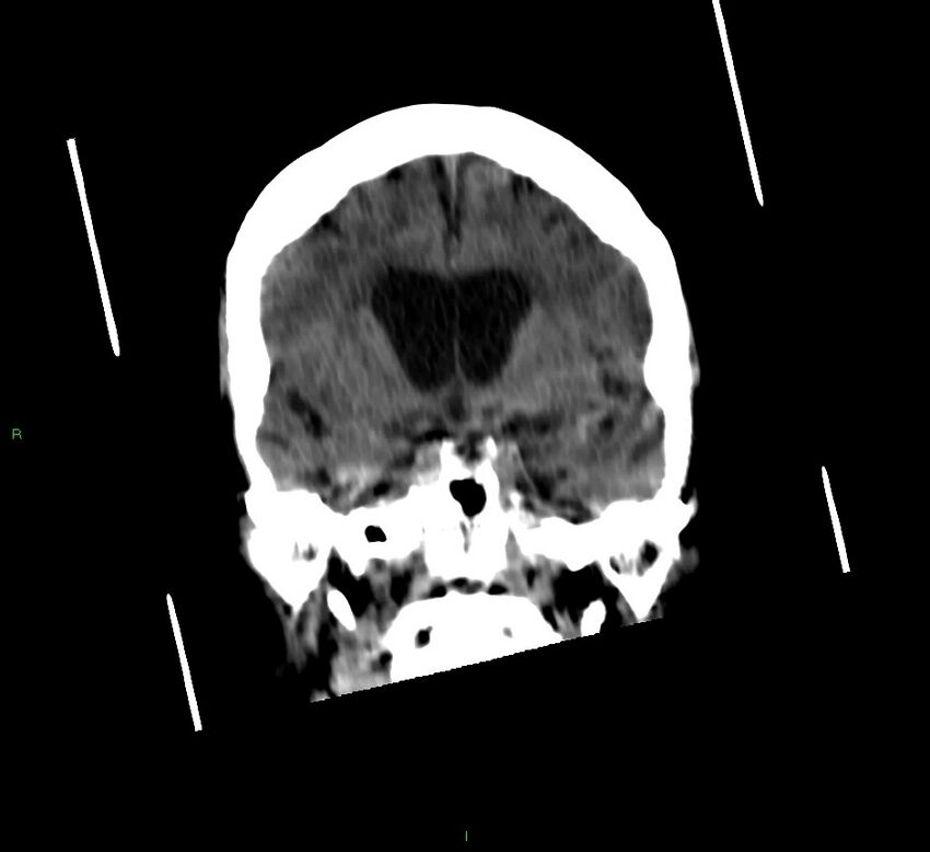 Cerebellar hemorrhage (Radiopaedia 58792-66026 Coronal non-contrast 39).jpg