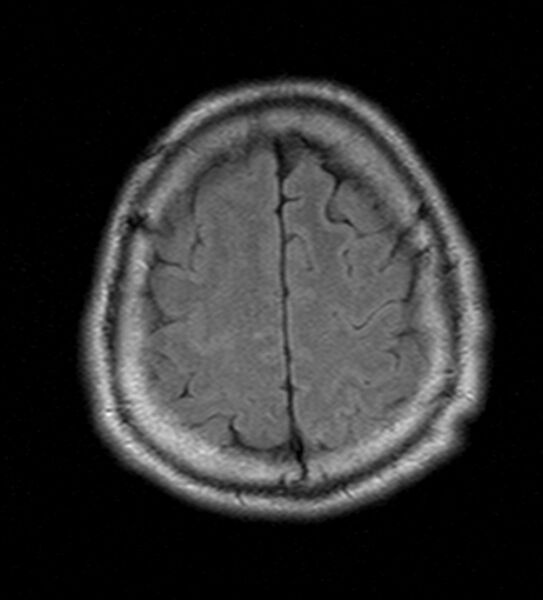 File:Cerebellopontine angle meningioma (Radiopaedia 24459-24764 Axial FLAIR 21).jpg