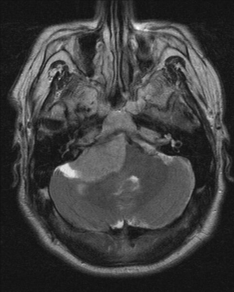 File:Cerebellopontine angle meningioma (Radiopaedia 24459-24764 Axial T2 5).jpg