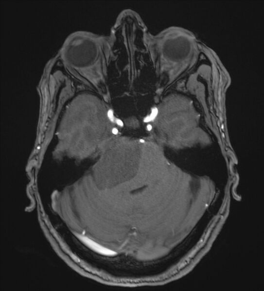 File:Cerebellopontine angle meningioma (Radiopaedia 72983-83680 Axial MRA 34).jpg