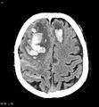 Cerebral abscesses secondary to contusions (Radiopaedia 5201-22213 Axial non-contrast 4).jpg