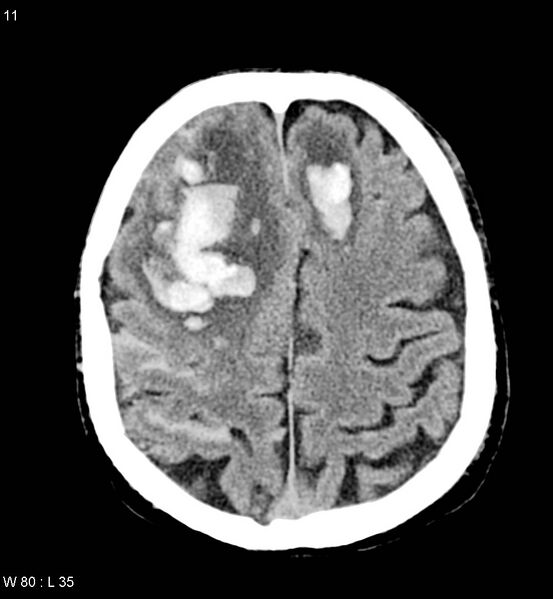 File:Cerebral abscesses secondary to contusions (Radiopaedia 5201-22213 Axial non-contrast 4).jpg