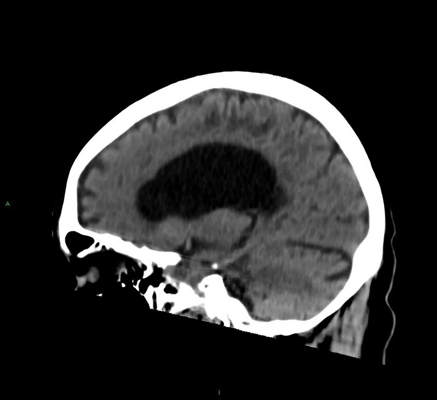 Cerebral amyloid angiopathy-associated lobar intracerebral hemorrhage (Radiopaedia 58376-65513 C 43).jpg