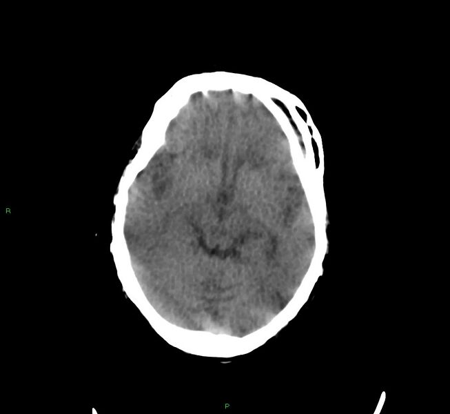 File:Cerebral amyloid angiopathy-associated lobar intracerebral hemorrhage (Radiopaedia 58377-65514 Axial non-contrast 30).jpg