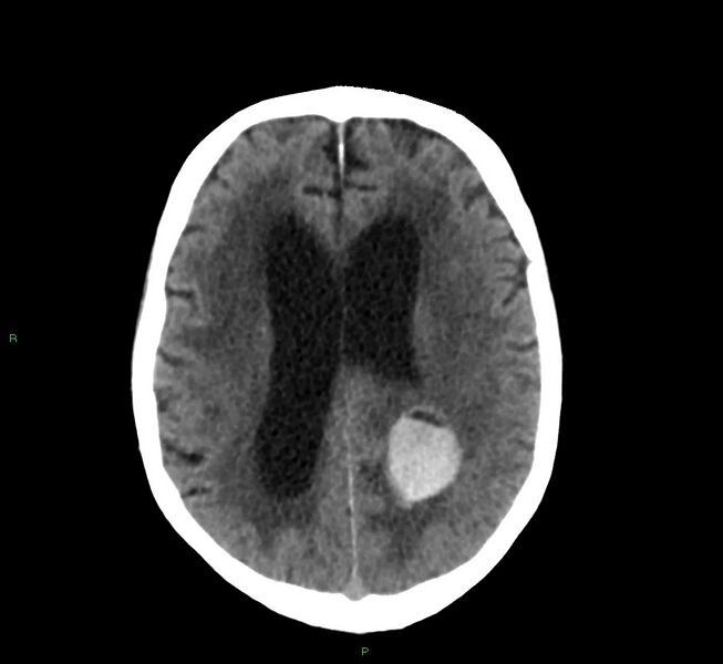 File:Cerebral amyloid angiopathy-associated lobar intracerebral hemorrhage (Radiopaedia 58530-65688 Axial non-contrast 19).jpg